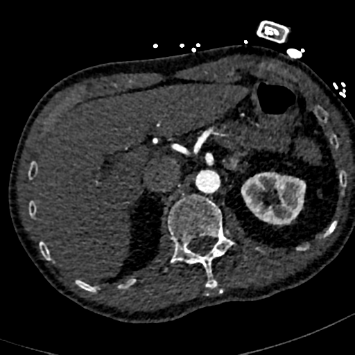 File:Aortic dissection - DeBakey type II (Radiopaedia 64302-73082 A 92).png