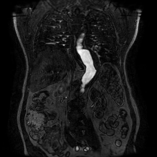 File:Aortic dissection - Stanford A - DeBakey I (Radiopaedia 23469-23551 D 159).jpg