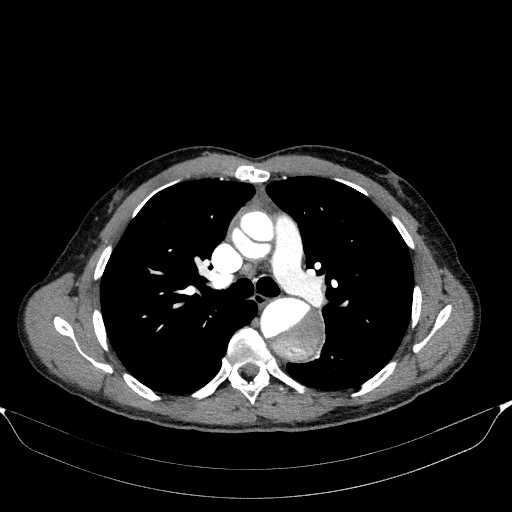 Aortic dissection - Stanford type A (Radiopaedia 83418-98500 A 27).jpg