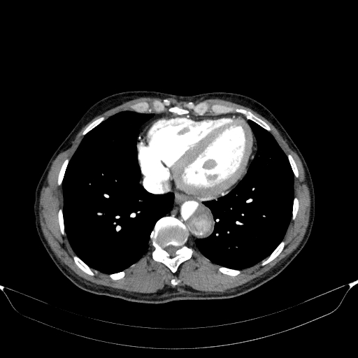 Aortic dissection - Stanford type A (Radiopaedia 83418-98500 A 47).jpg
