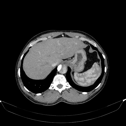 File:Aortic dissection - Stanford type A (Radiopaedia 83418-98500 A 57).jpg