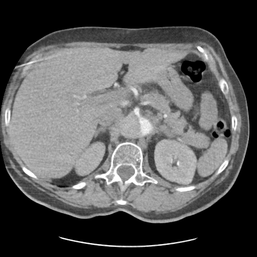 File:Aortic dissection - Stanford type B (Radiopaedia 50171-55512 A 50).png