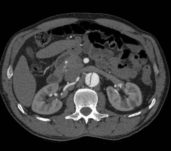Aortic dissection - Stanford type B (Radiopaedia 73648-84437 A 142).jpg