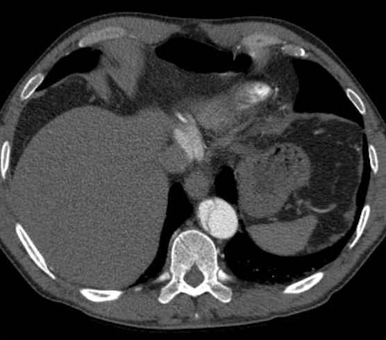 Aortic dissection - Stanford type B (Radiopaedia 73648-84437 A 95).jpg