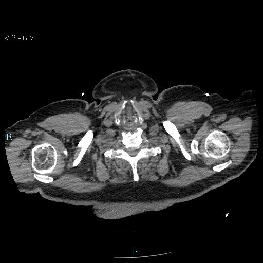 Aortic intramural hematoma (Radiopaedia 48463-53380 Axial non-contrast 2).jpg