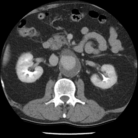 Aortic intramural hematoma (type B) (Radiopaedia 79323-92387 Axial C+ delayed 67).jpg
