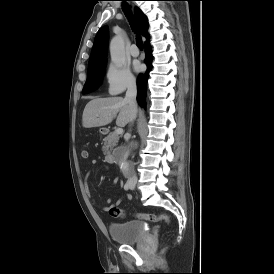 Aortic intramural hematoma (type B) (Radiopaedia 79323-92387 Sagittal C+ delayed 22).jpg