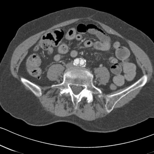 Aortic intramural hematoma from penetrating atherosclerotic ulcer (Radiopaedia 31137-31836 A 128).jpg