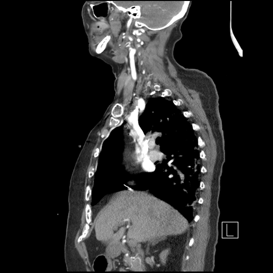 Aortic intramural hematoma with dissection and intramural blood pool (Radiopaedia 77373-89491 D 32).jpg