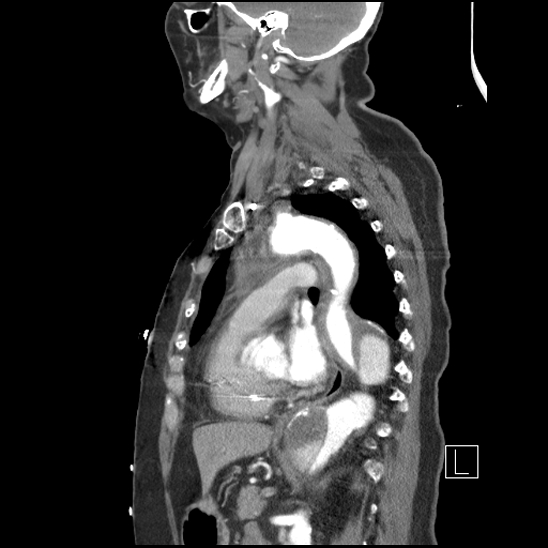 Aortic intramural hematoma with dissection and intramural blood pool (Radiopaedia 77373-89491 D 52).jpg