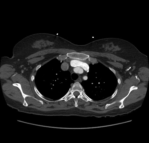 Aortic nipple (Radiopaedia 63008-71449 B 24).jpg