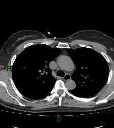 Aortic valve endocarditis (Radiopaedia 87209-103485 Axial non-contrast 36).jpg