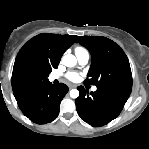 File:Aortic valve non-coronary cusp thrombus (Radiopaedia 55661-62189 B 25).png