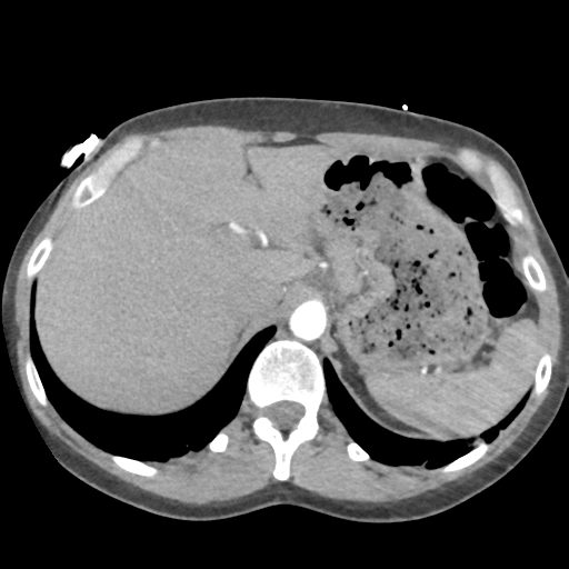 File:Aortic valve non-coronary cusp thrombus (Radiopaedia 55661-62189 B 49).png