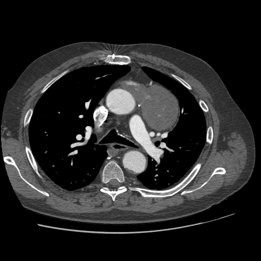 File:Aorto-coronary bypass graft aneurysms (Radiopaedia 40562-43157 A 44).png