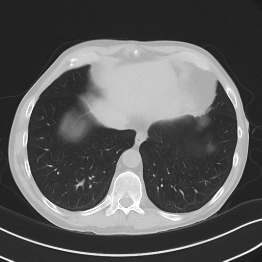 Apical pulmonary metastasis (Radiopaedia 46338-50754 Axial non-contrast 51).png