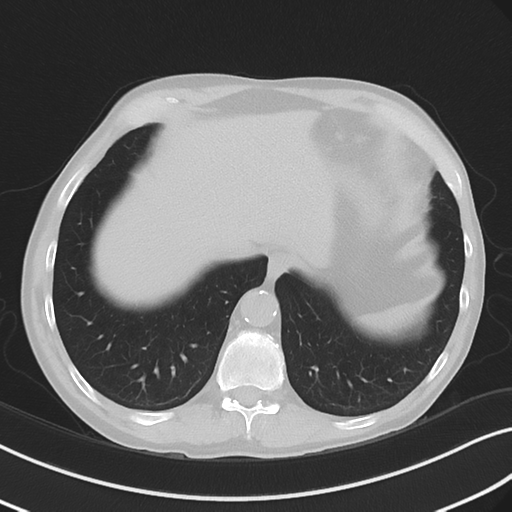 Apical pulmonary metastasis (Radiopaedia 46338-50754 Axial non-contrast 53).png