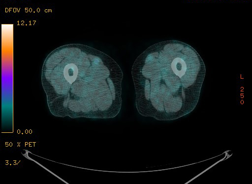 File:Appendiceal adenocarcinoma complicated by retroperitoneal abscess (Radiopaedia 58007-65041 Axial PET-CT 224).jpg