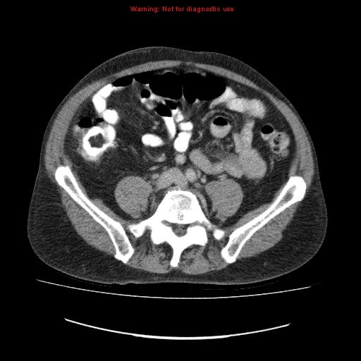 File:Appendicitis mass in inguinal hernia (Radiopaedia 26858-27029 A 2).jpg