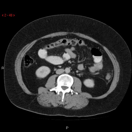 File:Appendicitis with microperforation- promontoric type (Radiopaedia 27268-27442 C 36).jpg