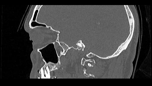 Arcuate foramen (Radiopaedia 89833-106944 Sagittal bone window 101).jpg