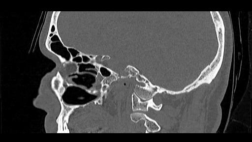 Arcuate foramen (Radiopaedia 89833-106944 Sagittal bone window 29).jpg