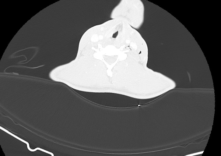 Arrow injury in the neck (Radiopaedia 75268-86390 Axial lung window 188).jpg