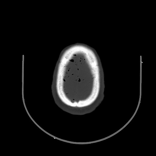 Arrow injury to the brain (Radiopaedia 72101-82607 Axial bone window 90).jpg