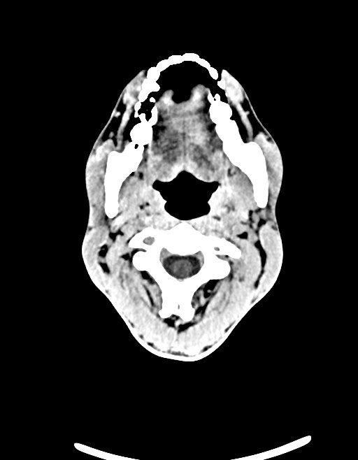Arrow injury to the brain (Radiopaedia 72101-82607 Axial non-contrast 38).jpg