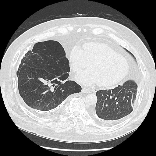 Asbestos-related pleural disease (Radiopaedia 74366-85250 Axial lung window 78).jpg