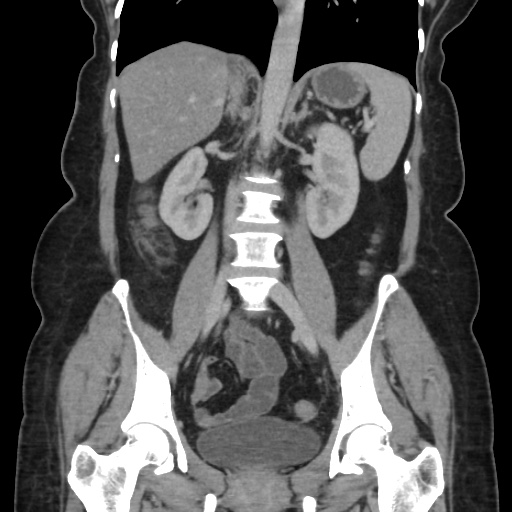 Ascending colon diverticulitis (Radiopaedia 61970-70040 B 37).jpg