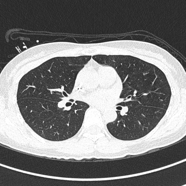 File:Aspergilloma (Radiopaedia 26223-26347 Axial lung window 40).jpg