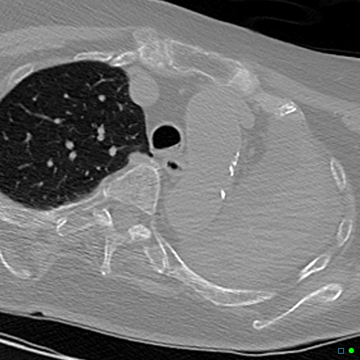 File:Aspirated food bolus obstruction of left main bronchus (Radiopaedia 29432-29904 Axial non-contrast 6).jpg