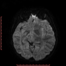 Astroblastoma (Radiopaedia 74287-85162 Axial DWI 42).jpg