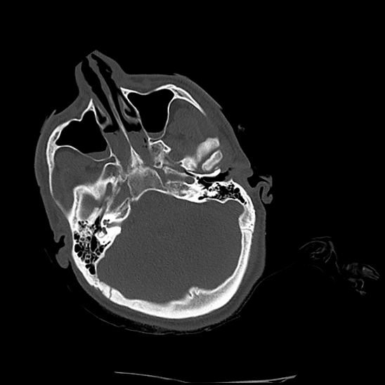 Atlanto-occipital dissociation (Traynelis type 1), C2 teardrop fracture, C6-7 facet joint dislocation (Radiopaedia 87655-104061 Axial bone window 1).jpg