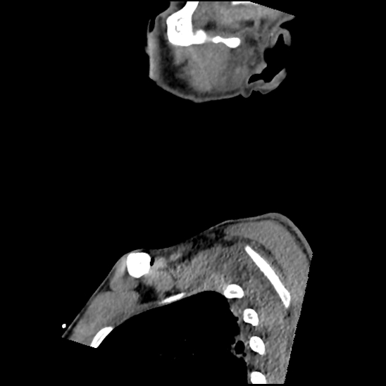 Atlanto-occipital dissociation (Traynelis type 1), C2 teardrop fracture, C6-7 facet joint dislocation (Radiopaedia 87655-104061 D 8).jpg