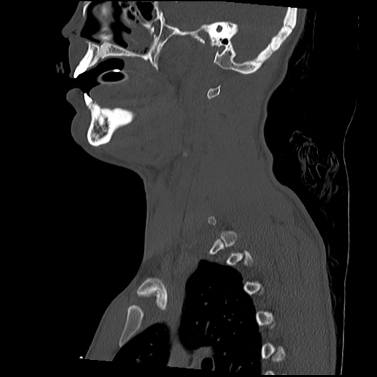 File:Atlanto-occipital dissociation (Traynelis type 1), C2 teardrop fracture, C6-7 facet joint dislocation (Radiopaedia 87655-104061 Sagittal bone window 19).jpg