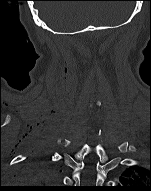 Atlanto-occipital dissociation - Traynelis type 1 (Radiopaedia 87570-103948 Coronal bone window 47).jpg