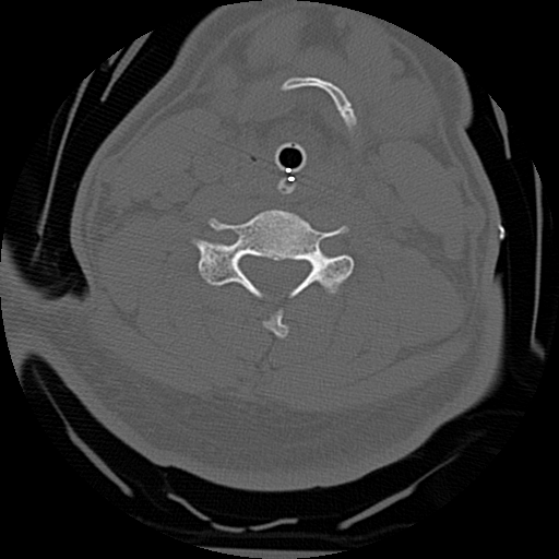 Atlanto-occipital dissociation injury (Radiopaedia 29274-29698 Axial bone window 46).png