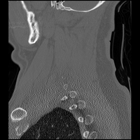 Atlanto-occipital dissociation injury (Radiopaedia 29274-29698 Sagittal bone window 47).png