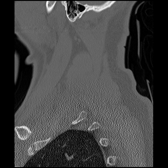 Atlanto-occipital dissociation injury (Radiopaedia 29274-29698 Sagittal bone window 53).png