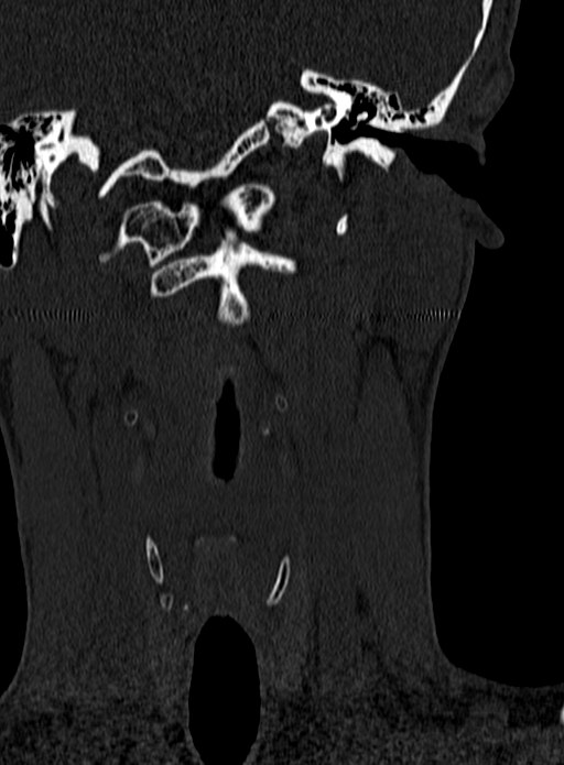 Atlantoaxial subluxation (Radiopaedia 44681-48450 Coronal bone window 7).jpg