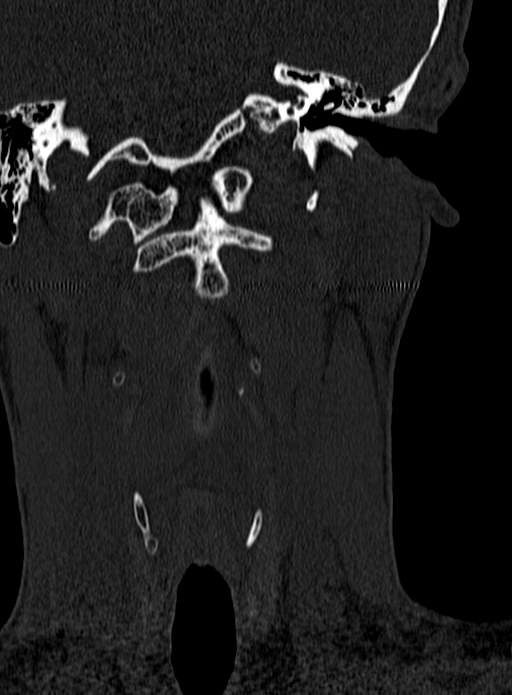 Atlantoaxial subluxation (Radiopaedia 44681-48450 Coronal bone window 9).jpg