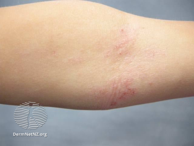 File:Atopic dermatitis (DermNet NZ dermatitis-flexural-eczema08).jpg