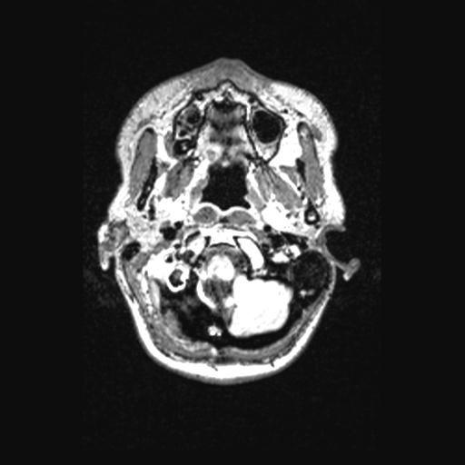 Atretic encephalocoele with inferior vermis hypoplasia (Radiopaedia 30443-31108 Axial 22).jpg
