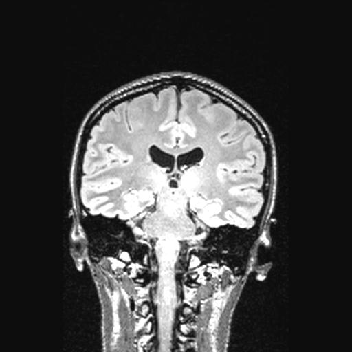 Atretic encephalocoele with inferior vermis hypoplasia (Radiopaedia 30443-31108 Coronal FLAIR 81).jpg