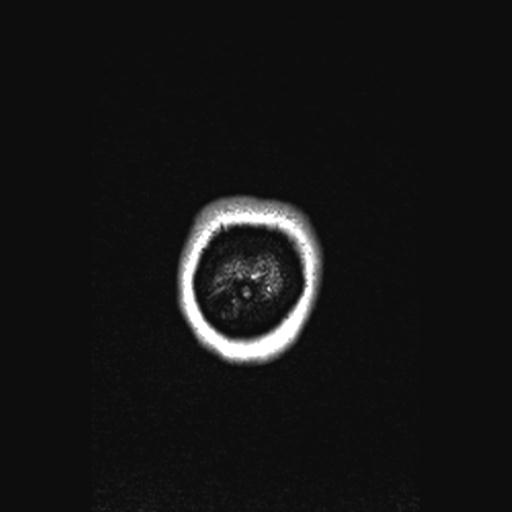Atretic encephalocoele with inferior vermis hypoplasia (Radiopaedia 30443-31108 Coronal FLAIR 9).jpg