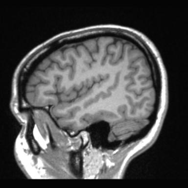 Atretic encephalocoele with inferior vermis hypoplasia (Radiopaedia 30443-31108 Sagittal T1 24).jpg