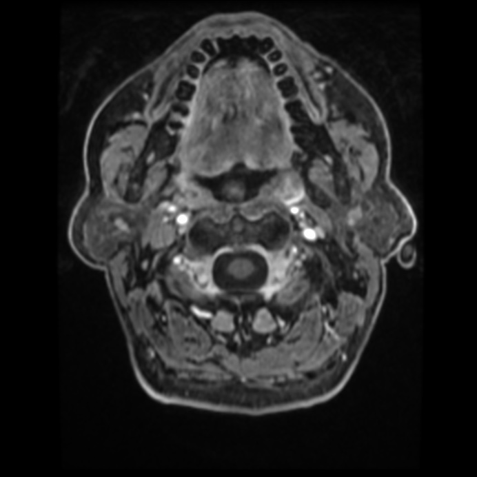 Atypical meningioma (Radiopaedia 45535-49629 Axial T1 C+ 8).jpg