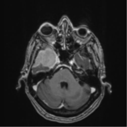 Atypical meningioma (WHO Grade II) (Radiopaedia 54742-60979 Axial T1 C+ 15).png